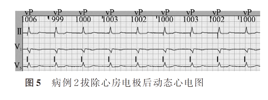 百多力起搏器怎么样两种心室起搏图形的3 种情况_https://www.jmylbn.com_新闻资讯_第7张