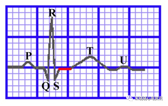 心电图纸的描述有哪些一文全解析 心电图到底该怎么看？_https://www.jmylbn.com_新闻资讯_第15张