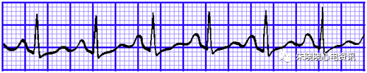 心电图纸的描述有哪些一文全解析 心电图到底该怎么看？_https://www.jmylbn.com_新闻资讯_第22张