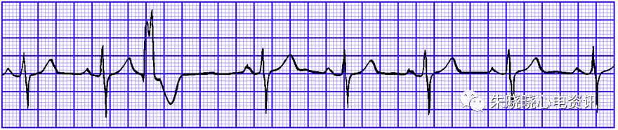 心电图纸的描述有哪些一文全解析 心电图到底该怎么看？_https://www.jmylbn.com_新闻资讯_第24张