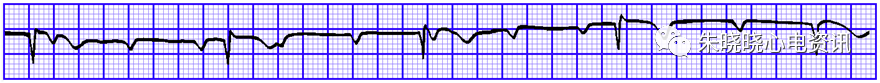 心电图纸的描述有哪些一文全解析 心电图到底该怎么看？_https://www.jmylbn.com_新闻资讯_第31张