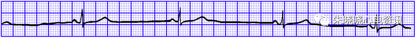 心电图纸的描述有哪些一文全解析 心电图到底该怎么看？_https://www.jmylbn.com_新闻资讯_第21张
