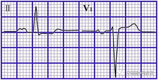 心电图纸的描述有哪些一文全解析 心电图到底该怎么看？_https://www.jmylbn.com_新闻资讯_第18张