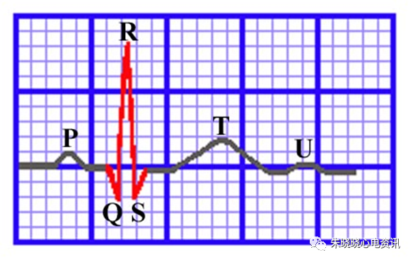 心电图纸的描述有哪些一文全解析 心电图到底该怎么看？_https://www.jmylbn.com_新闻资讯_第10张
