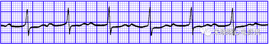 心电图纸的描述有哪些一文全解析 心电图到底该怎么看？_https://www.jmylbn.com_新闻资讯_第29张