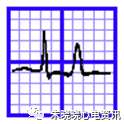 心电图纸的描述有哪些一文全解析 心电图到底该怎么看？_https://www.jmylbn.com_新闻资讯_第25张