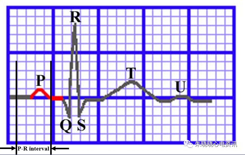 心电图纸的描述有哪些一文全解析 心电图到底该怎么看？_https://www.jmylbn.com_新闻资讯_第14张