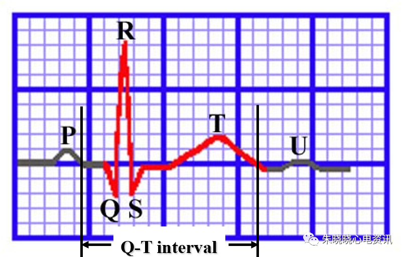 心电图纸的描述有哪些一文全解析 心电图到底该怎么看？_https://www.jmylbn.com_新闻资讯_第16张