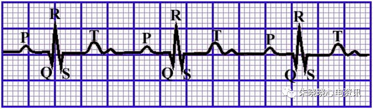 心电图纸的描述有哪些一文全解析 心电图到底该怎么看？_https://www.jmylbn.com_新闻资讯_第17张