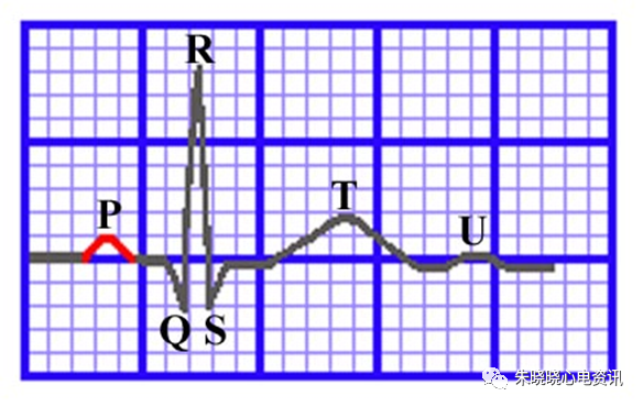 心电图纸的描述有哪些一文全解析 心电图到底该怎么看？_https://www.jmylbn.com_新闻资讯_第9张