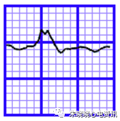 心电图纸的描述有哪些一文全解析 心电图到底该怎么看？_https://www.jmylbn.com_新闻资讯_第27张
