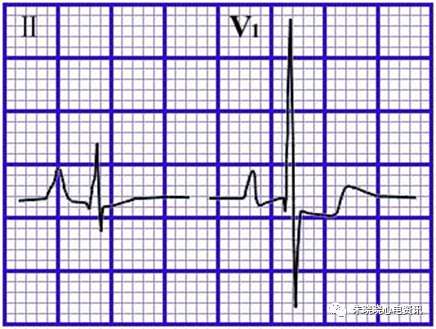 心电图纸的描述有哪些一文全解析 心电图到底该怎么看？_https://www.jmylbn.com_新闻资讯_第19张