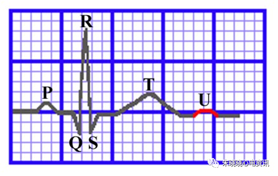 心电图纸的描述有哪些一文全解析 心电图到底该怎么看？_https://www.jmylbn.com_新闻资讯_第13张