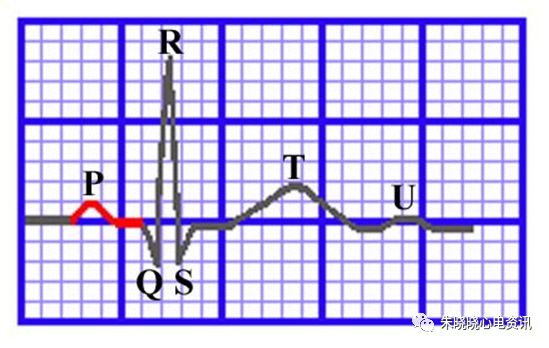 心电图纸怎么看【临床实用心电图入门】第三讲：心电图的测量要点_https://www.jmylbn.com_新闻资讯_第8张