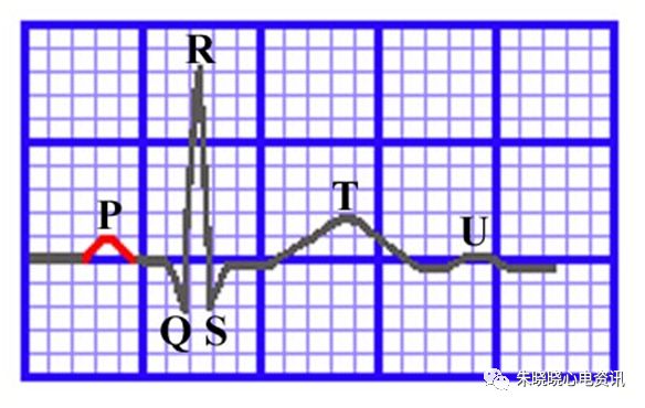 心电图纸怎么看【临床实用心电图入门】第三讲：心电图的测量要点_https://www.jmylbn.com_新闻资讯_第6张