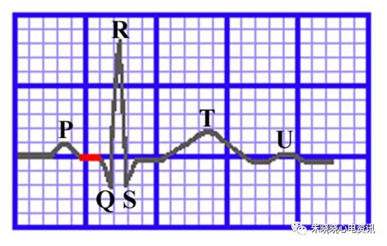 心电图纸怎么看【临床实用心电图入门】第三讲：心电图的测量要点_https://www.jmylbn.com_新闻资讯_第7张