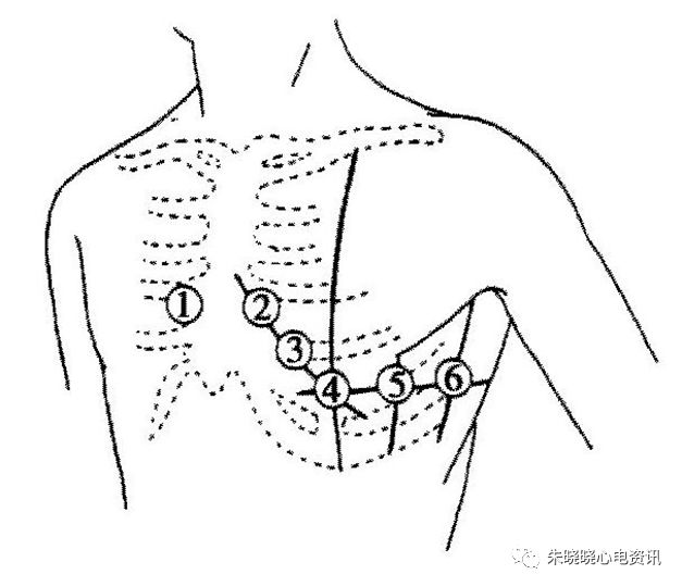 心电图怎么切换导联临床实用心电图入门系列之二：心电图导联、波形及临床价值_https://www.jmylbn.com_新闻资讯_第9张