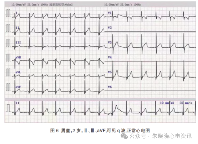 胎儿心电图是什么意思儿童心脏发育与心电图概述_https://www.jmylbn.com_新闻资讯_第11张
