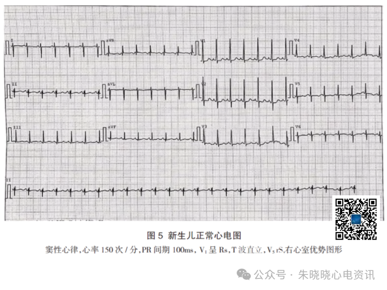 胎儿心电图是什么意思儿童心脏发育与心电图概述_https://www.jmylbn.com_新闻资讯_第9张