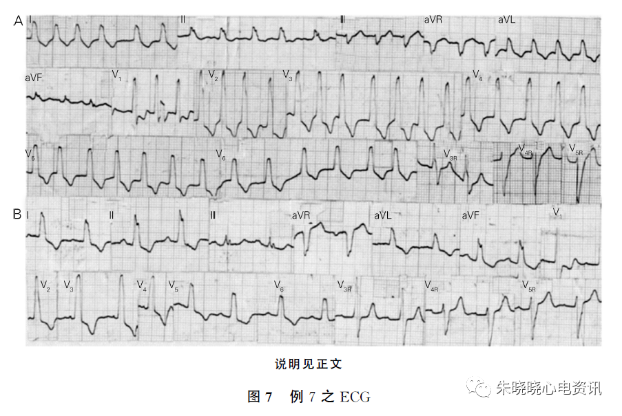 极易误诊为室性心动过速的几种情况