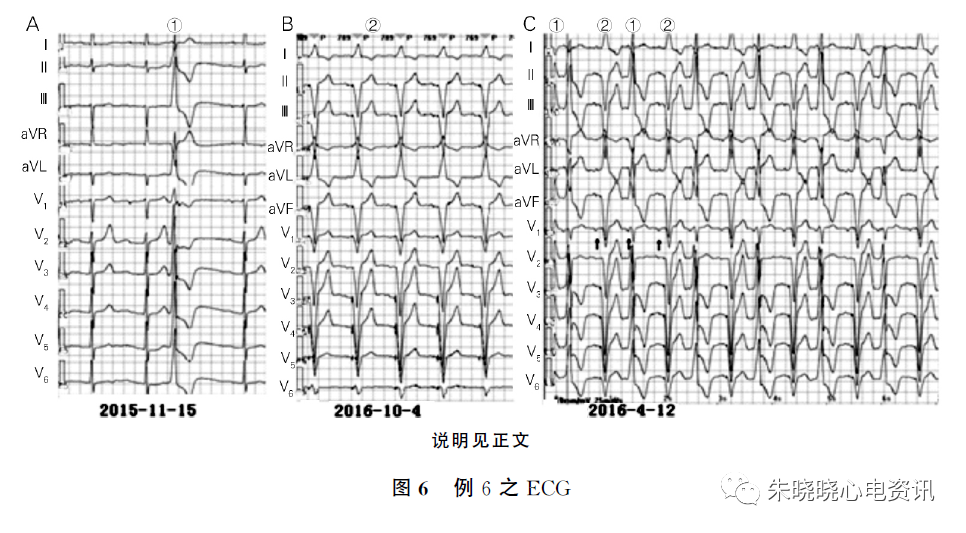 极易误诊为室性心动过速的几种情况