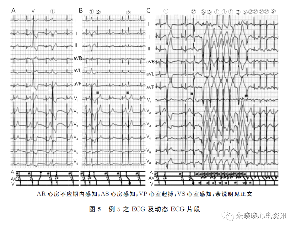 极易误诊为室性心动过速的几种情况