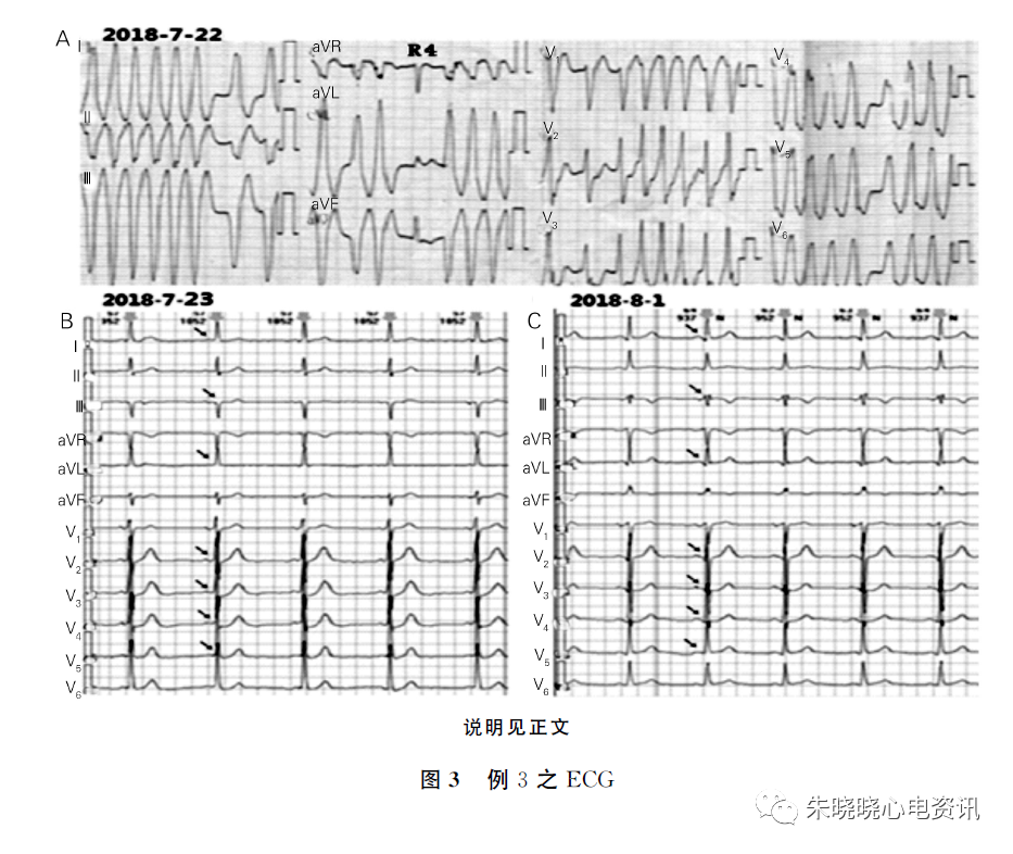 极易误诊为室性心动过速的几种情况