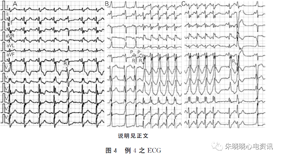 极易误诊为室性心动过速的几种情况