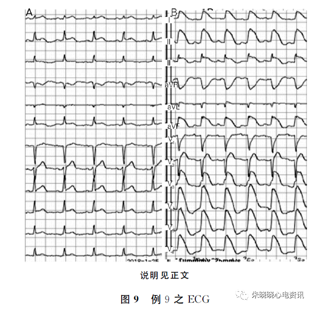 极易误诊为室性心动过速的几种情况