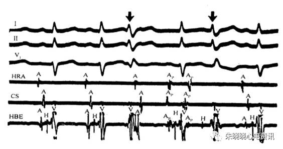 什么是同步心电图卢喜烈教授心电系列之四十三：室性早搏的心电图基本特征_https://www.jmylbn.com_新闻资讯_第2张