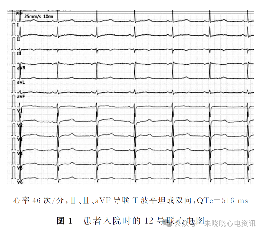 动态心电图怎么分析心脏性猝死患者的动态心电表现及分析_https://www.jmylbn.com_新闻资讯_第3张
