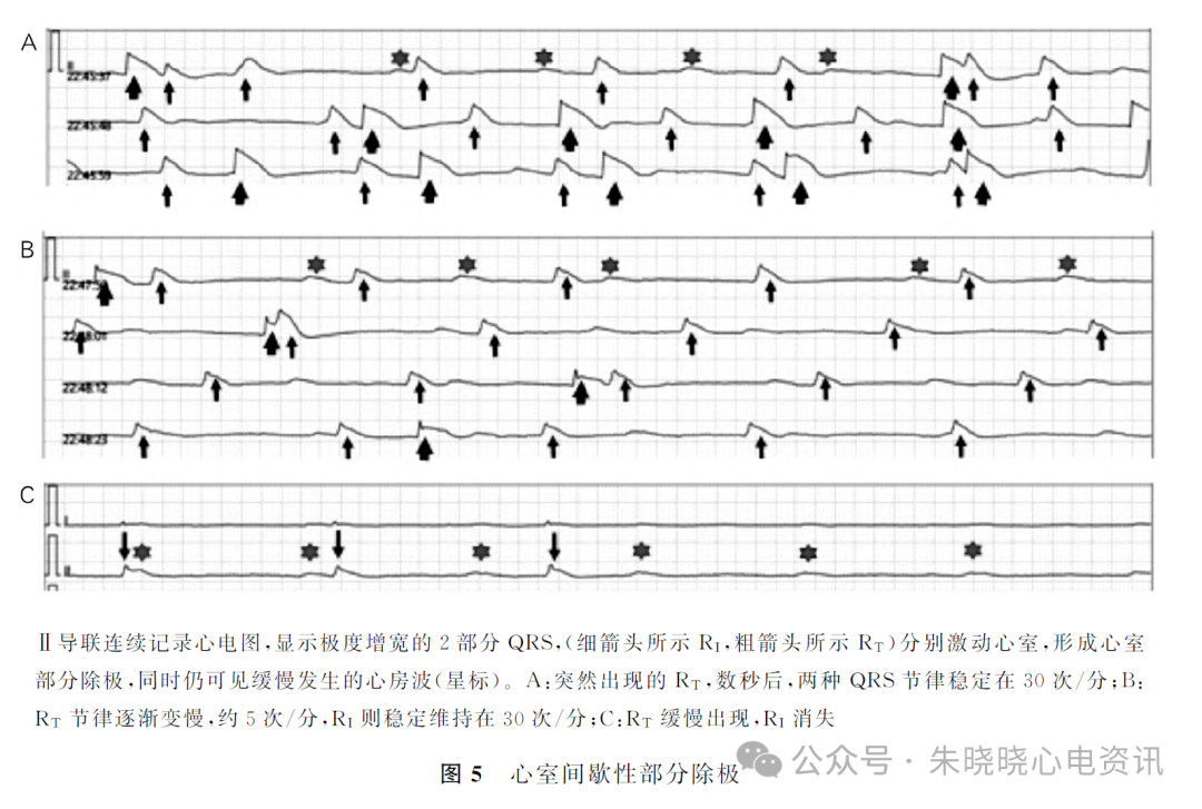 动态心电图怎么分析心脏性猝死患者的动态心电表现及分析_https://www.jmylbn.com_新闻资讯_第7张
