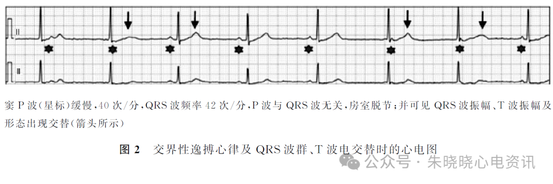 动态心电图怎么分析心脏性猝死患者的动态心电表现及分析_https://www.jmylbn.com_新闻资讯_第4张