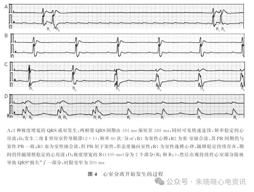 动态心电图怎么分析心脏性猝死患者的动态心电表现及分析_https://www.jmylbn.com_新闻资讯_第6张