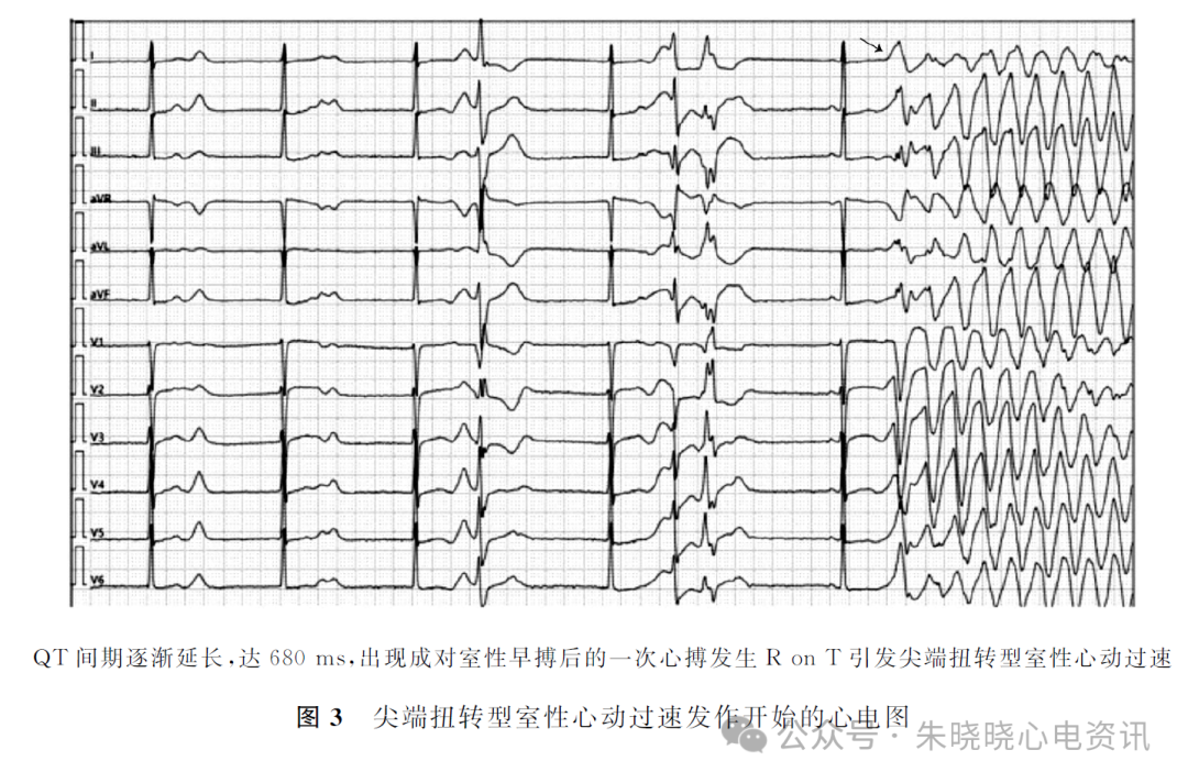 动态心电图怎么分析心脏性猝死患者的动态心电表现及分析_https://www.jmylbn.com_新闻资讯_第5张
