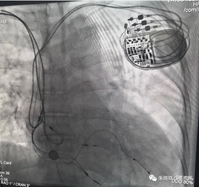 百多力起搏器怎么样“贴心”的通过胸片识别起搏器方法，让你秒懂_https://www.jmylbn.com_新闻资讯_第20张