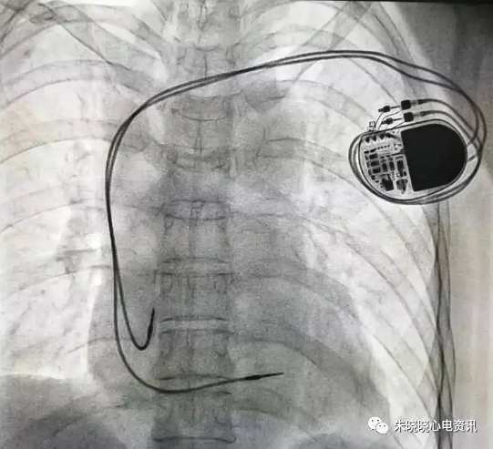 百多力起搏器怎么样“贴心”的通过胸片识别起搏器方法，让你秒懂_https://www.jmylbn.com_新闻资讯_第2张