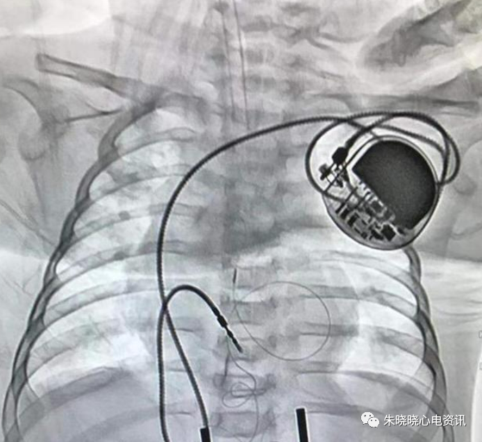 百多力起搏器怎么样“贴心”的通过胸片识别起搏器方法，让你秒懂_https://www.jmylbn.com_新闻资讯_第17张