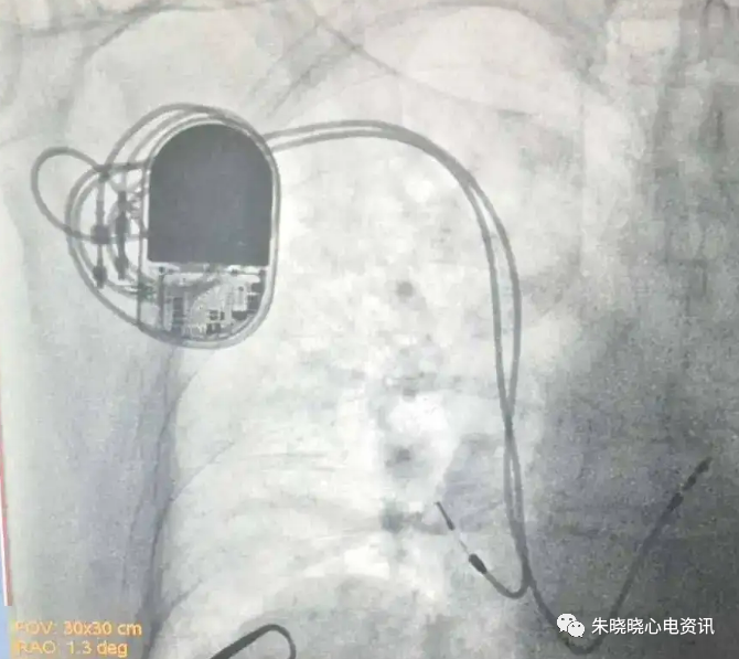 百多力起搏器怎么样“贴心”的通过胸片识别起搏器方法，让你秒懂_https://www.jmylbn.com_新闻资讯_第18张