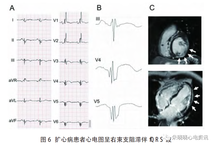 心电图滤波怎么选择北京大学人民医院许原：碎裂QRS 波的诊断_https://www.jmylbn.com_新闻资讯_第7张
