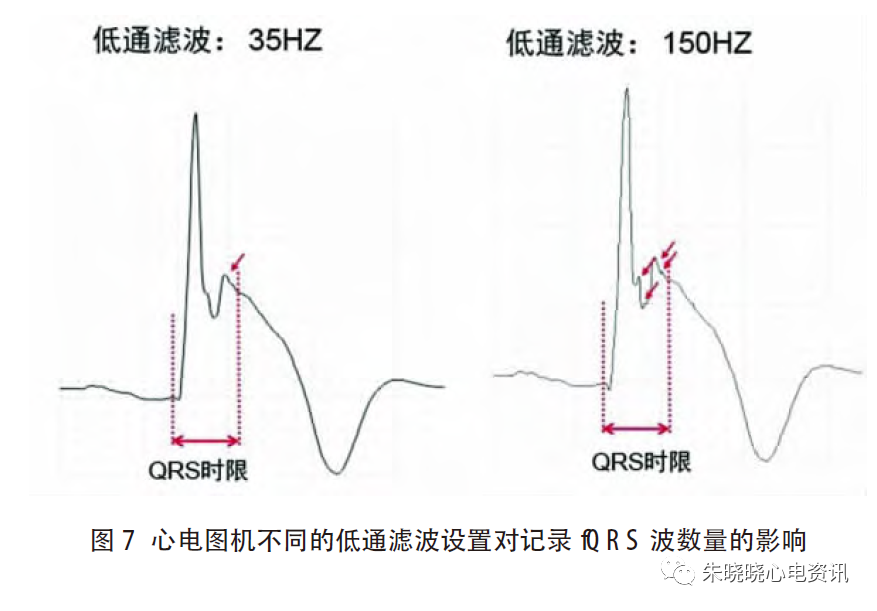心电图滤波怎么选择北京大学人民医院许原：碎裂QRS 波的诊断_https://www.jmylbn.com_新闻资讯_第8张