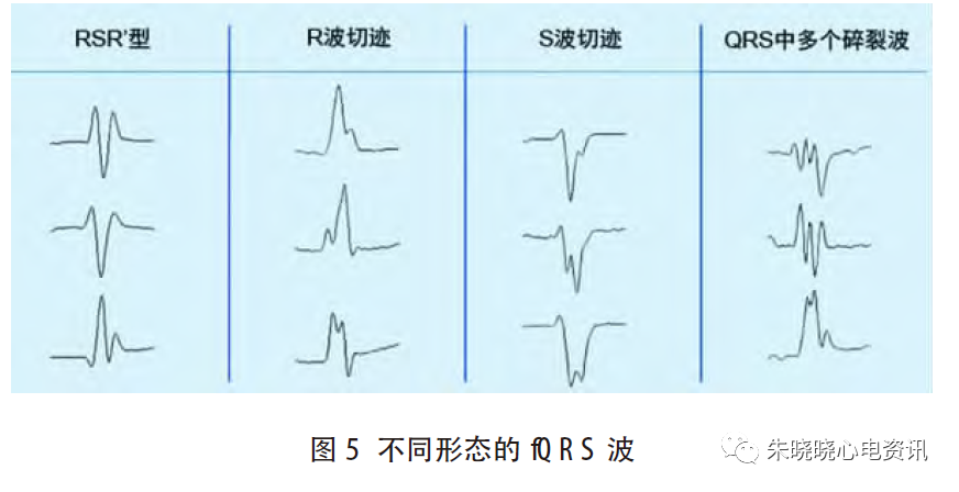 心电图滤波怎么选择北京大学人民医院许原：碎裂QRS 波的诊断_https://www.jmylbn.com_新闻资讯_第6张
