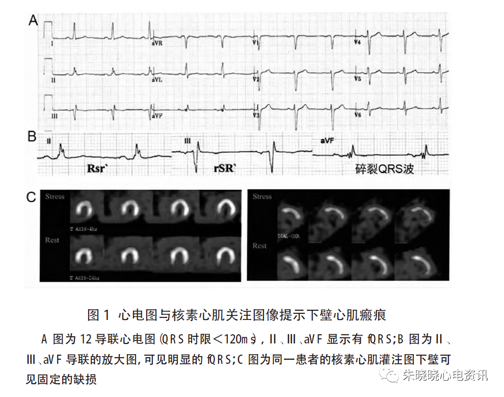 心电图滤波怎么选择北京大学人民医院许原：碎裂QRS 波的诊断_https://www.jmylbn.com_新闻资讯_第2张