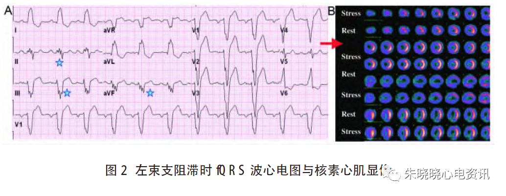 心电图滤波怎么选择北京大学人民医院许原：碎裂QRS 波的诊断_https://www.jmylbn.com_新闻资讯_第3张