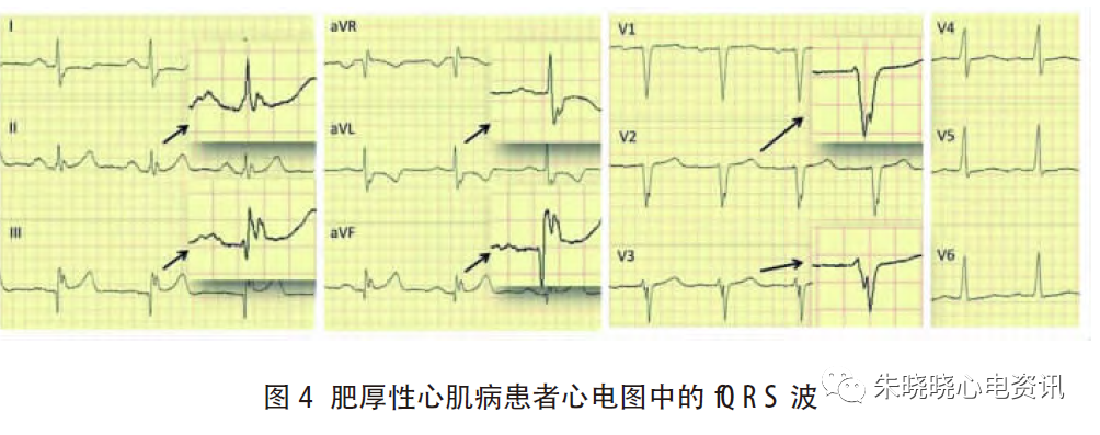 心电图滤波怎么选择北京大学人民医院许原：碎裂QRS 波的诊断_https://www.jmylbn.com_新闻资讯_第5张