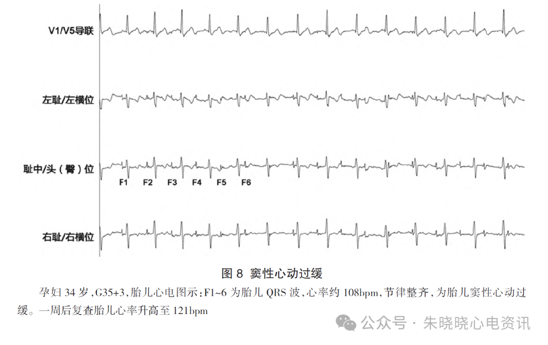 胎儿心电图是什么意思胎儿心电图精要_https://www.jmylbn.com_新闻资讯_第11张