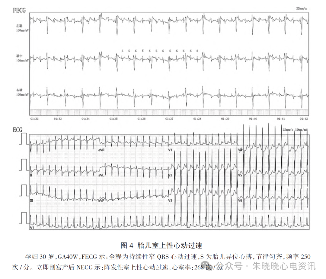 胎儿心电图是什么意思胎儿心电图精要_https://www.jmylbn.com_新闻资讯_第7张