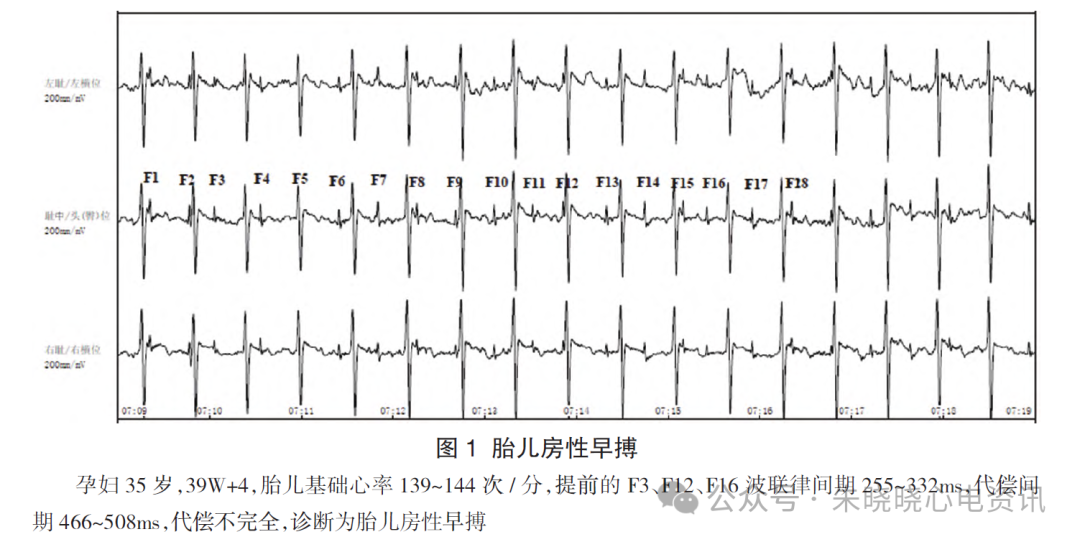 胎儿心电图是什么意思胎儿心电图精要_https://www.jmylbn.com_新闻资讯_第4张