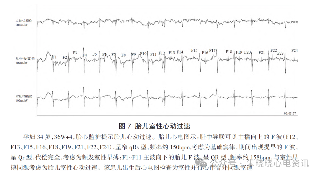 胎儿心电图是什么意思胎儿心电图精要_https://www.jmylbn.com_新闻资讯_第10张