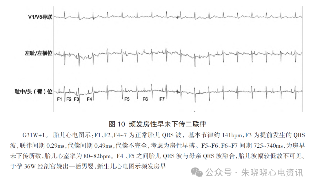 胎儿心电图是什么意思胎儿心电图精要_https://www.jmylbn.com_新闻资讯_第13张